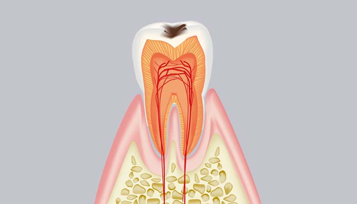 C1：エナメル質内の虫歯