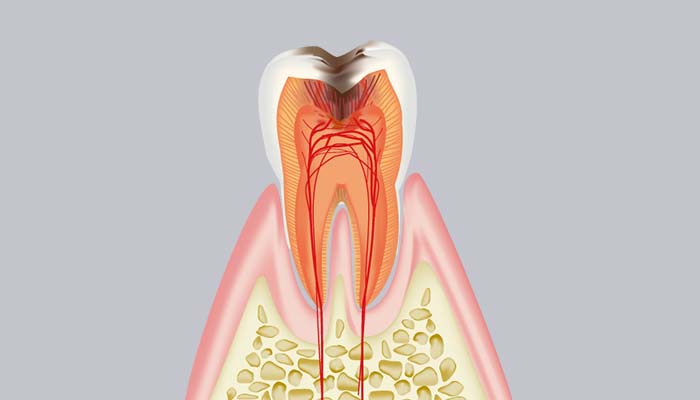 C3：歯髄に達した虫歯